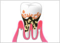 重度歯周炎のイメージ