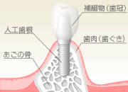 インプラントのイメージ